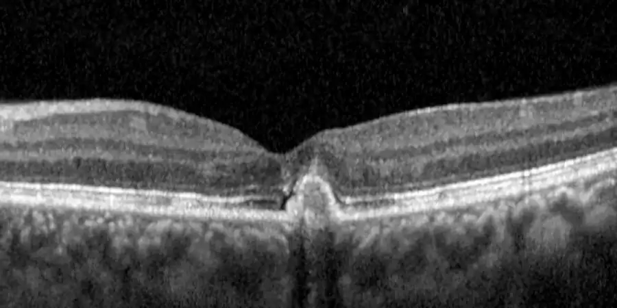 La misma retina después de las inyecciones: la fóvea ya está seca