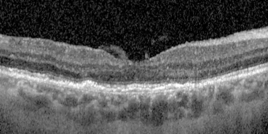 La misma retina después de las inyecciones: el líquido ha desaparecido