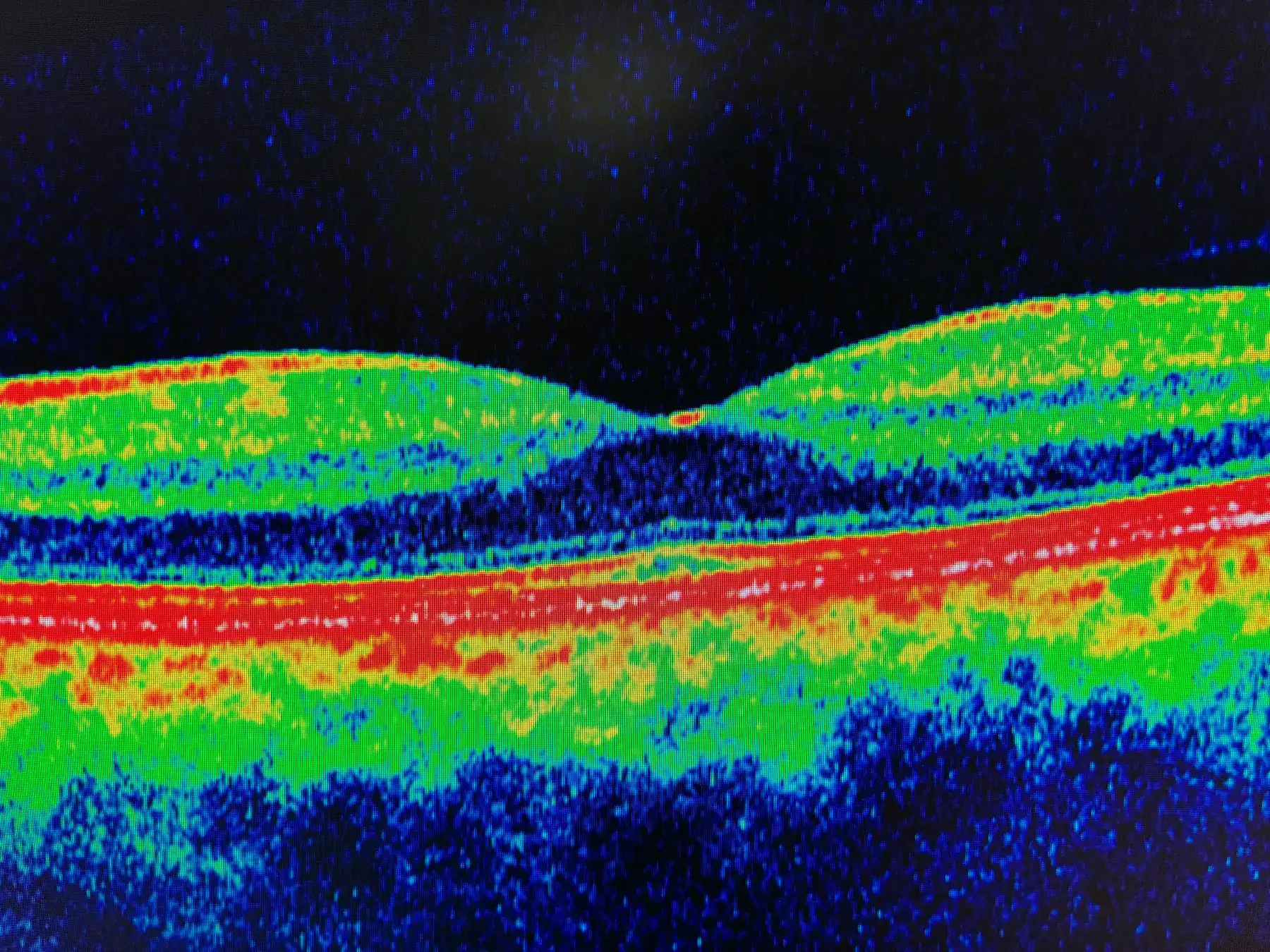 Optical coherence tomography (OCT) scan of the macula in false colour, taken at the clinic, showing the layers of the retina and the central dip of the fovea