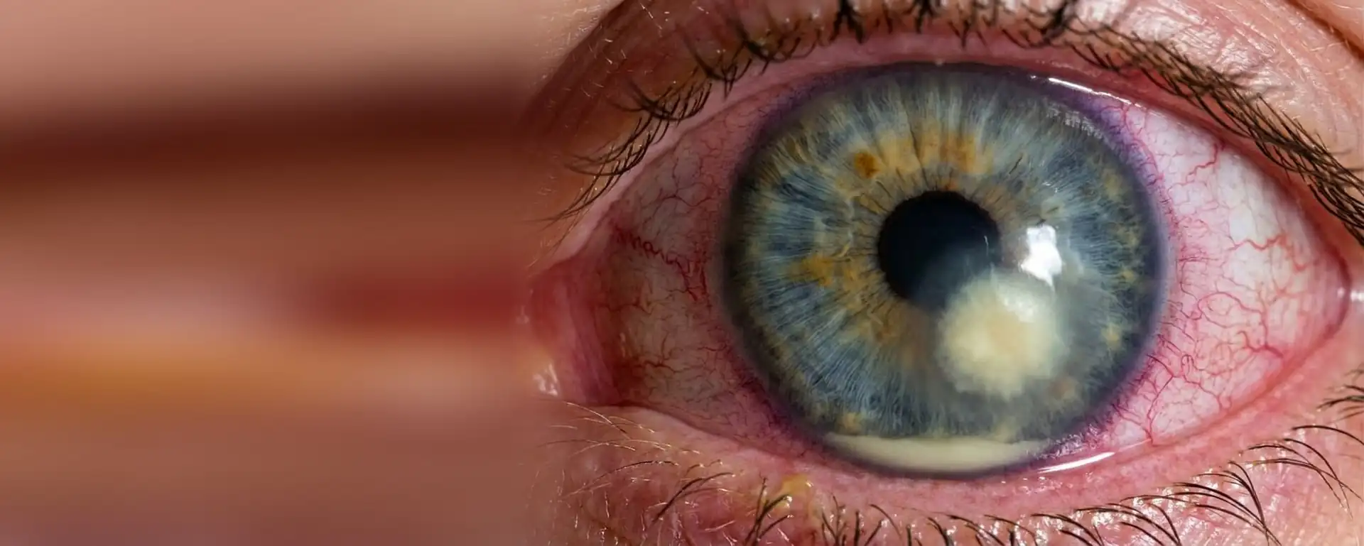 Red eye with a whitish abscess on the cornea and pus in the anterior chamber
